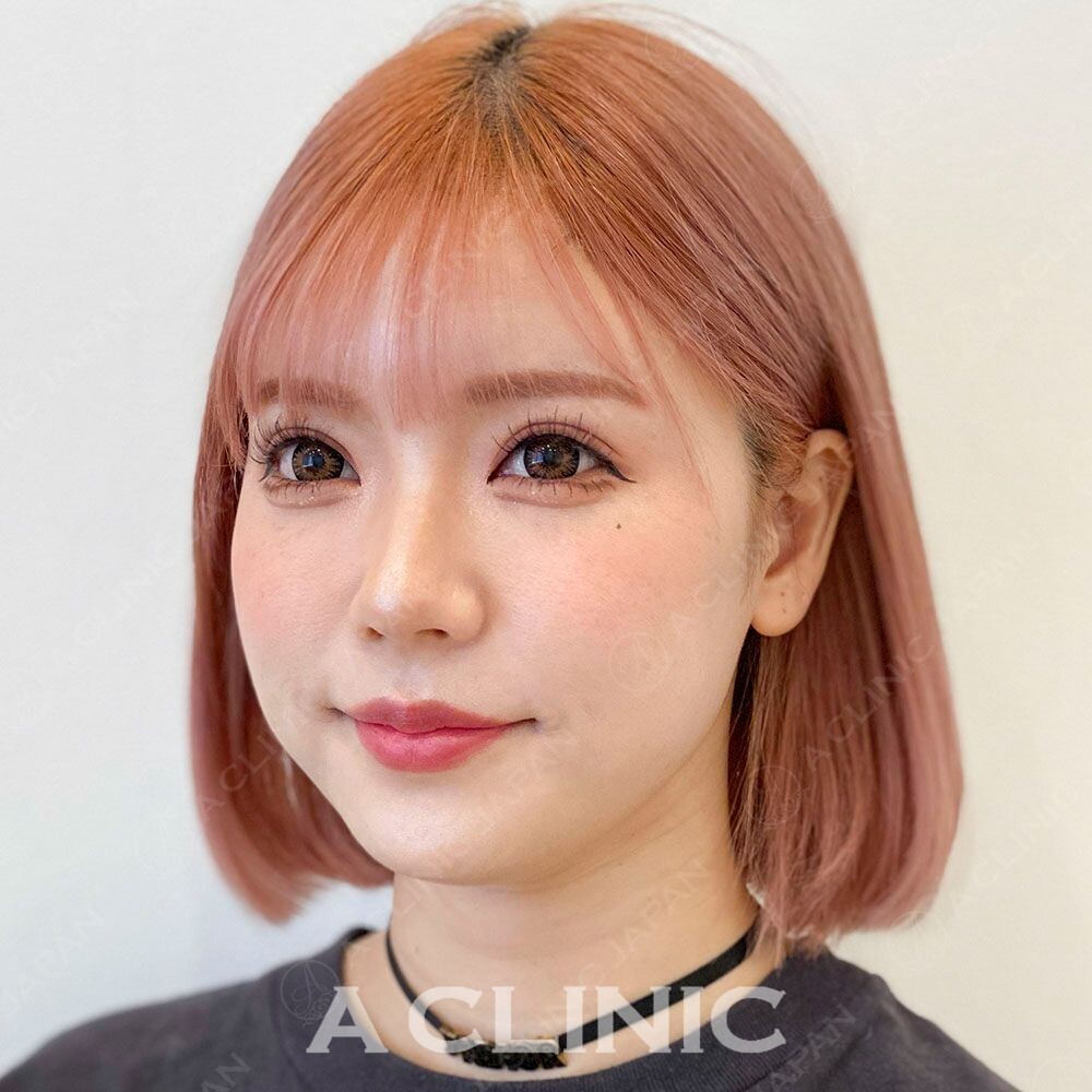 輪郭がくっきり変化！Aスレッド処置前と処置直後の症例です(20代女性) BEFORE