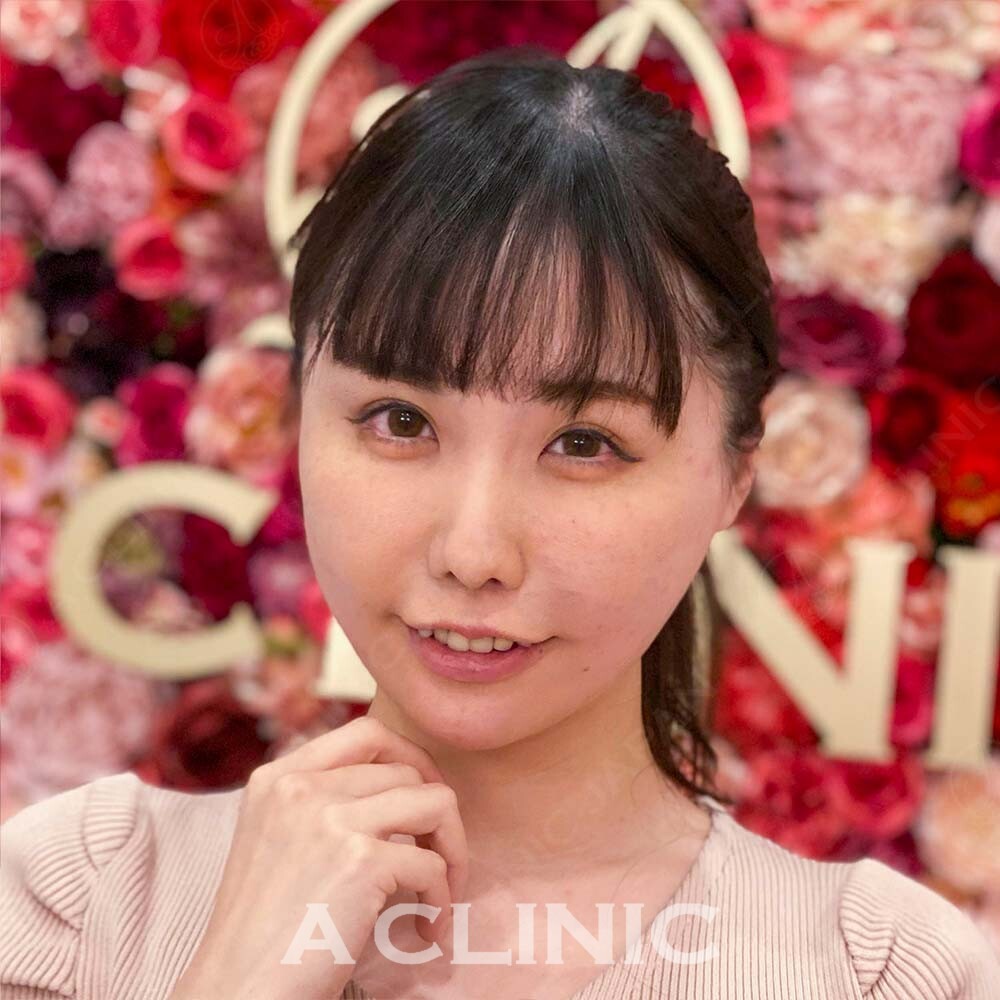 腫れない脂肪吸引なら1day小顔脂肪吸引！直後から圧倒的小顔に！処置前と処置直後の症例写真です(30代女性) AFTER