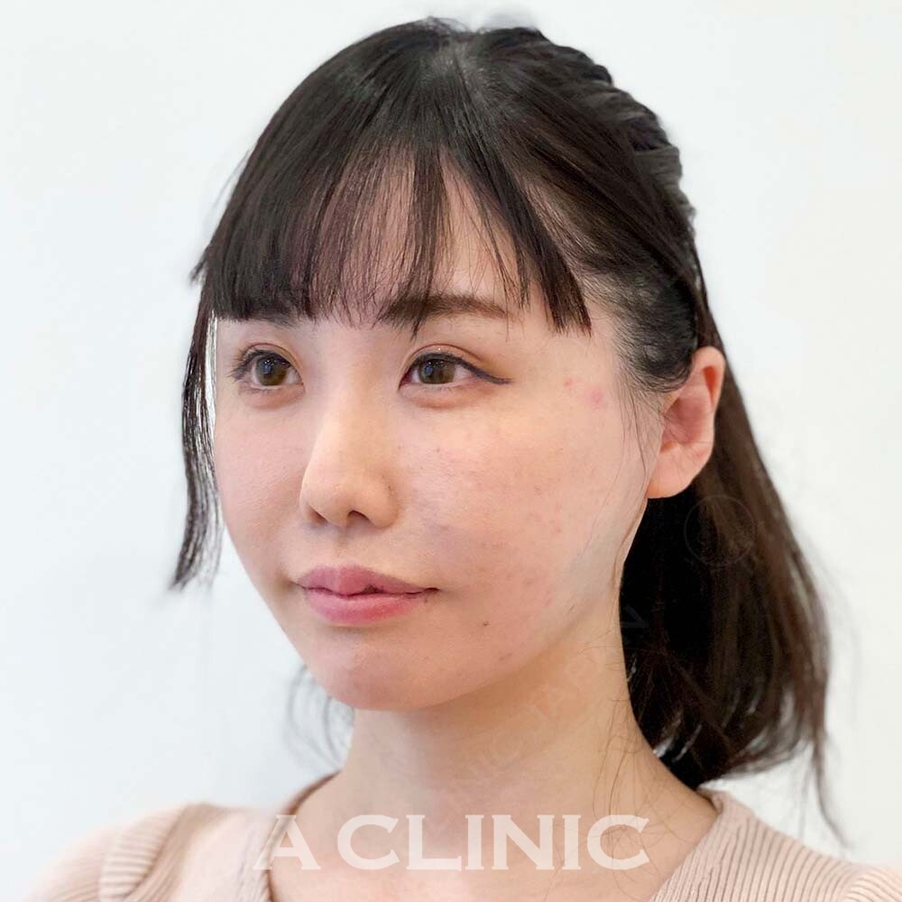 小顔になりたい方必見！大人気の1day小顔脂肪吸引でキュッと小顔になりませんか？こちら処置前と処置直後の症例です(30代女性) AFTER