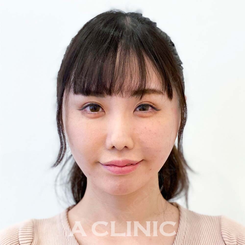 顔の脂肪吸引なら1day小顔脂肪吸引！腫れが最小限で半永久的に小顔に！処置前と処置直後の症例です(30代女性) AFTER