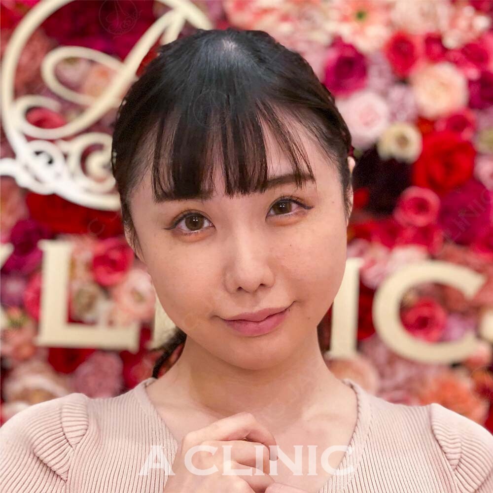 腫れない脂肪吸引なら1day小顔脂肪吸引！直後から圧倒的小顔に！処置前と処置直後の症例写真です(30代女性) BEFORE