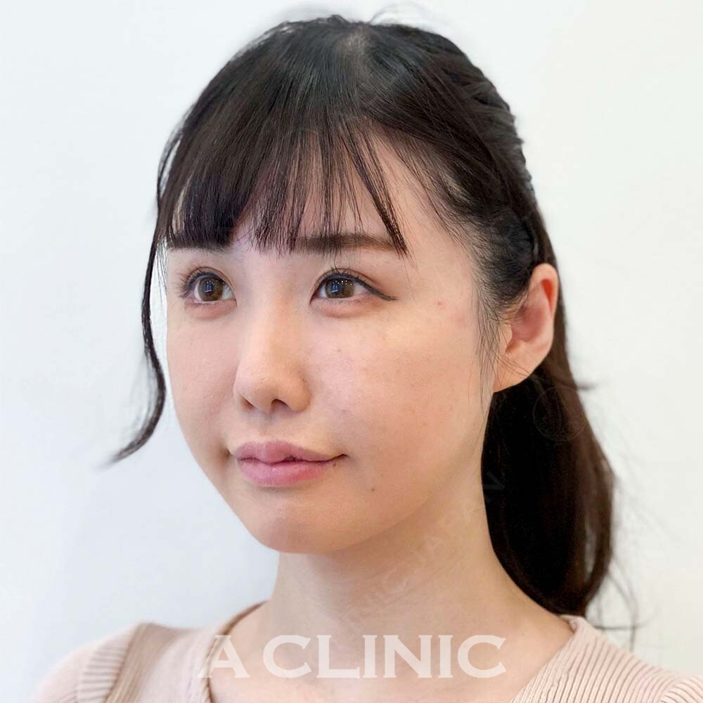 小顔になりたい方必見！大人気の1day小顔脂肪吸引でキュッと小顔になりませんか？こちら処置前と処置直後の症例です(30代女性) BEFORE