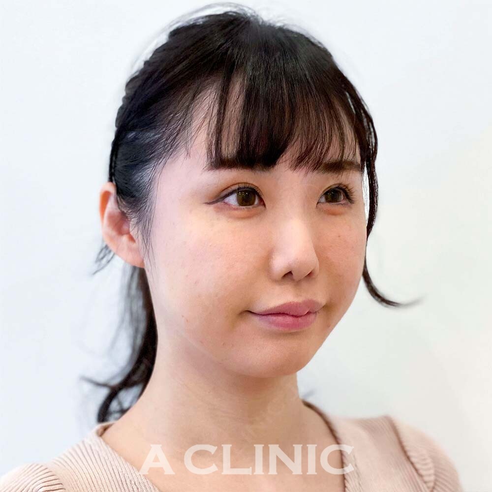 当日からメイク可能な脂肪吸引なら1day小顔脂肪吸引！処置前と処置直後にお撮りした症例写真です(30代女性) BEFORE