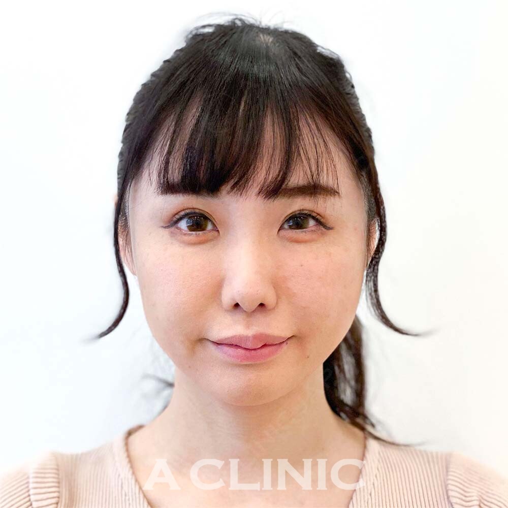 顔の脂肪吸引なら1day小顔脂肪吸引！腫れが最小限で半永久的に小顔に！処置前と処置直後の症例です(30代女性) BEFORE