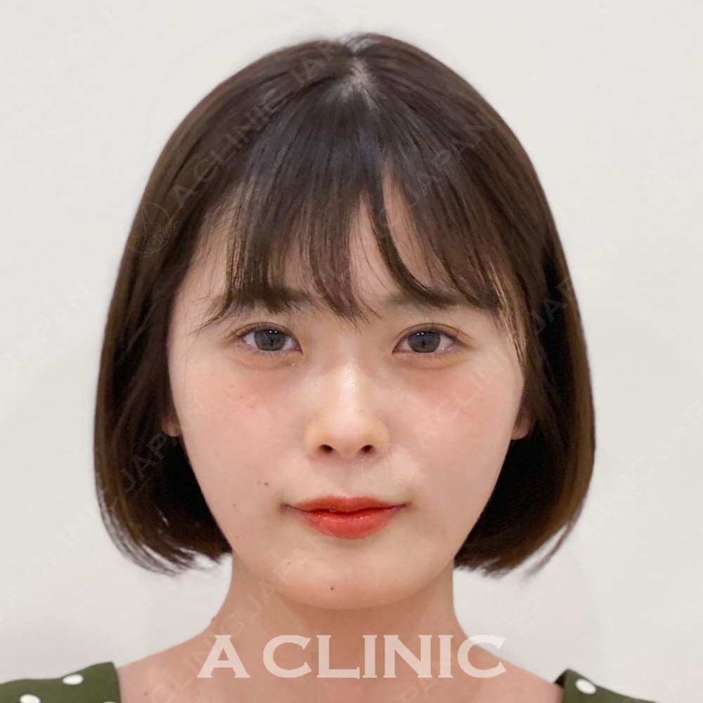 施術直後から小顔効果を実感したい方に！こちらはAスレッドの処置前と処置直後の症例です(20代女性) AFTER