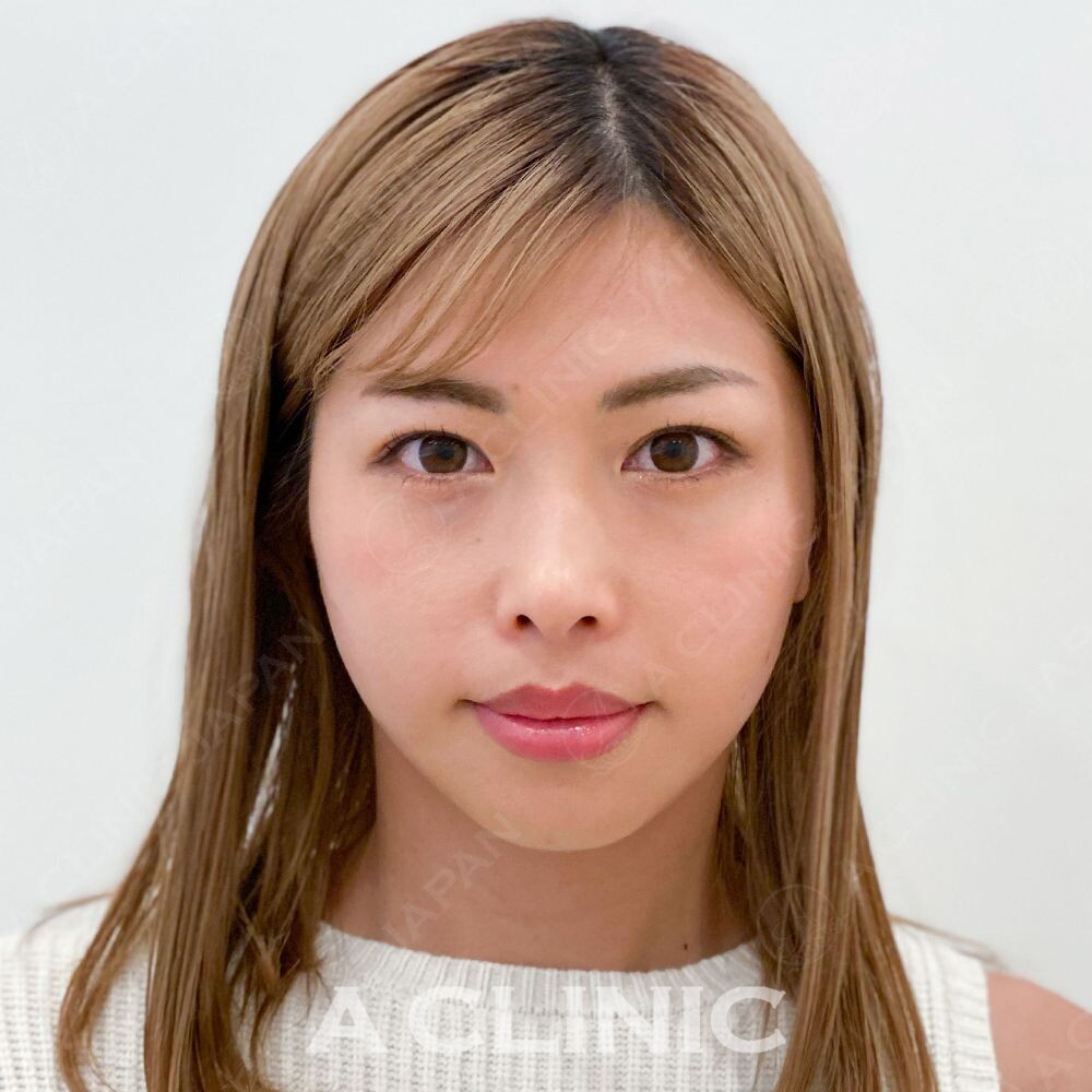 その日のうちに小顔になれるAスレッド！こちら処置前と処置直後の症例です(30代女性) AFTER