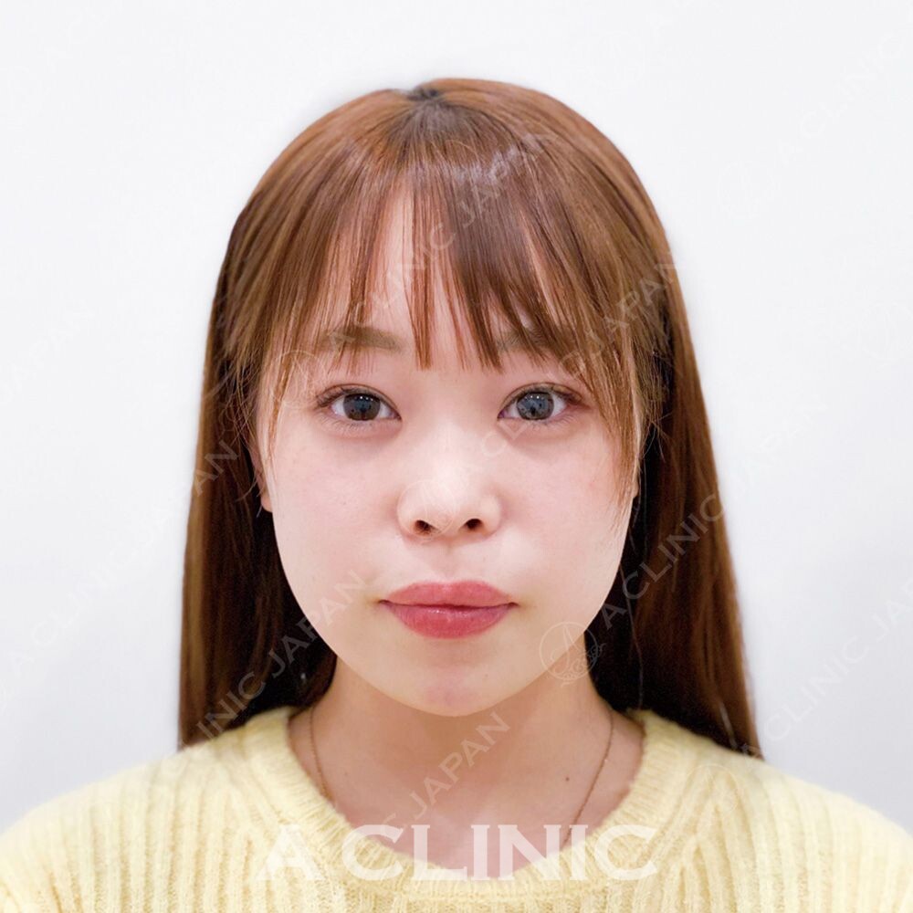 脂肪とたるみを両方リフトアップできます！小顔Aスレッドの処置前と処置直後の症例です(20代女性) AFTER