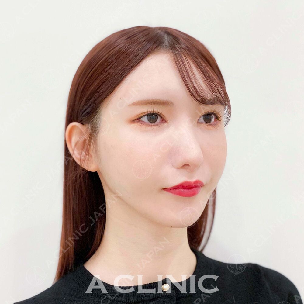 小顔と美肌ケアそしてアンチエイジングも叶う！Aスレッドの処置前と処置直後の症例です(20代女性) AFTER