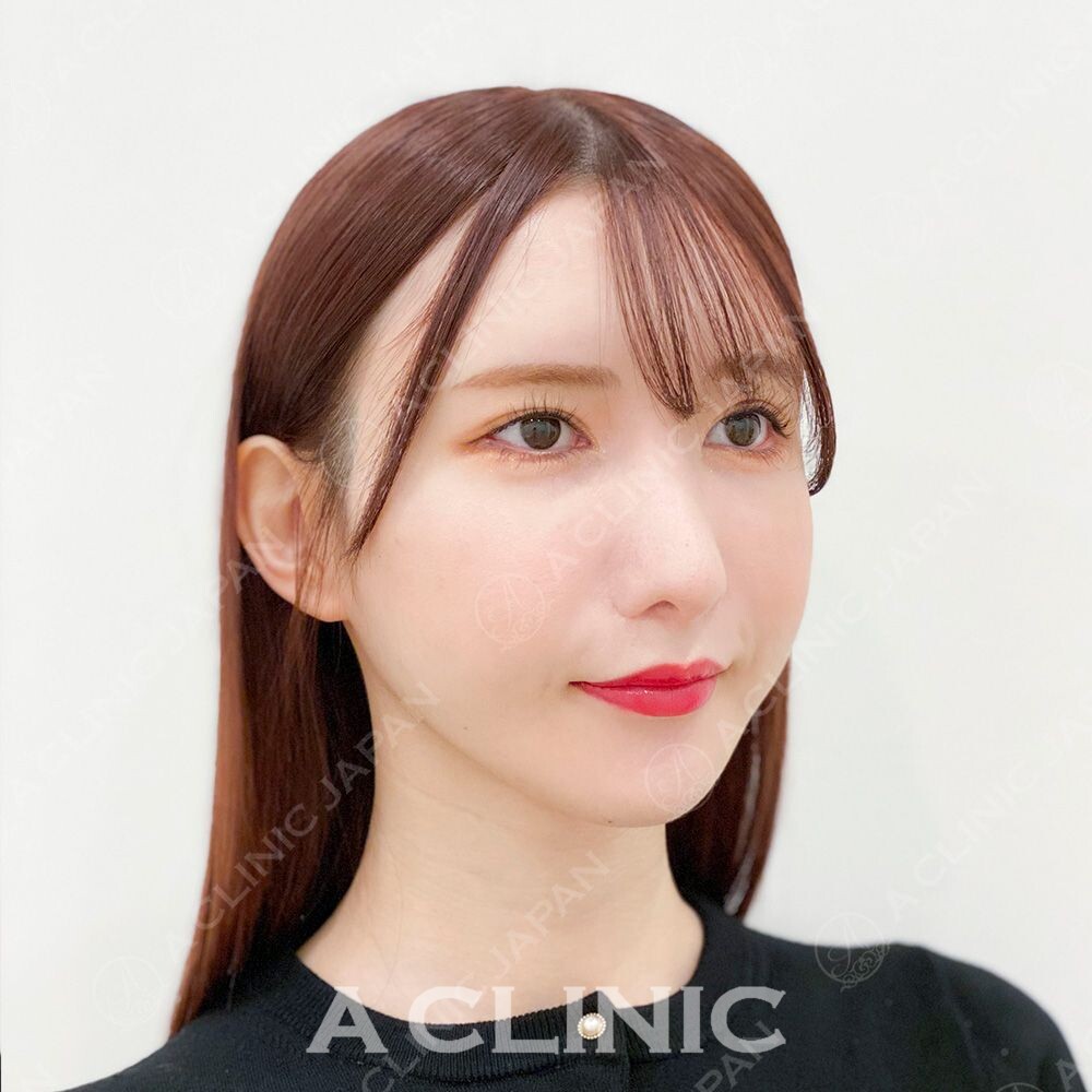 小顔と美肌ケアそしてアンチエイジングも叶う！Aスレッドの処置前と処置直後の症例です(20代女性) BEFORE