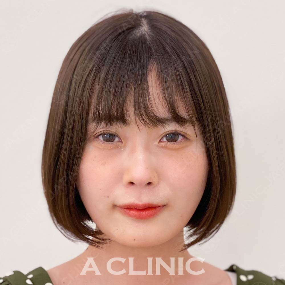 施術直後から小顔効果を実感したい方に！こちらはAスレッドの処置前と処置直後の症例です(20代女性) BEFORE