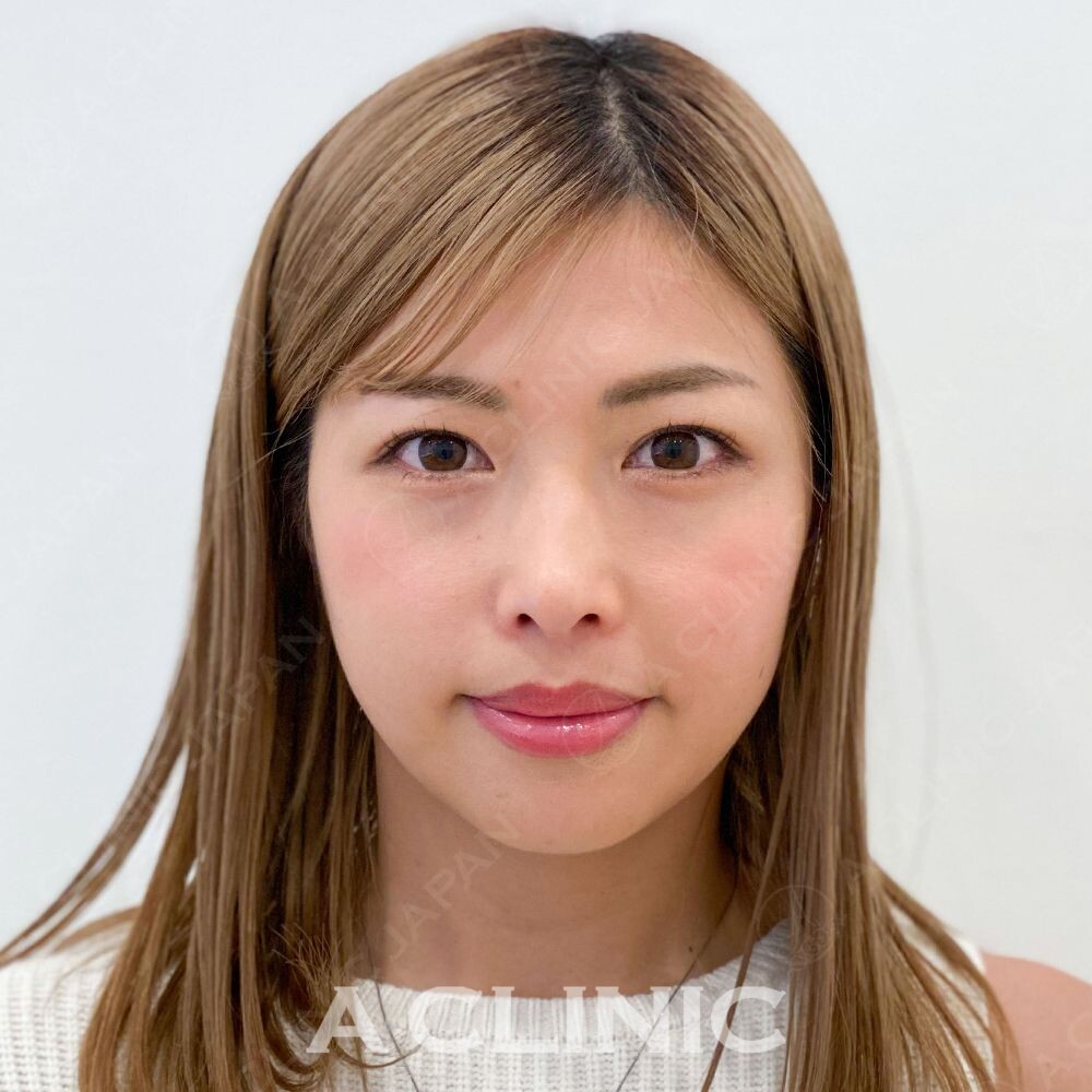 その日のうちに小顔になれるAスレッド！こちら処置前と処置直後の症例です(30代女性) BEFORE