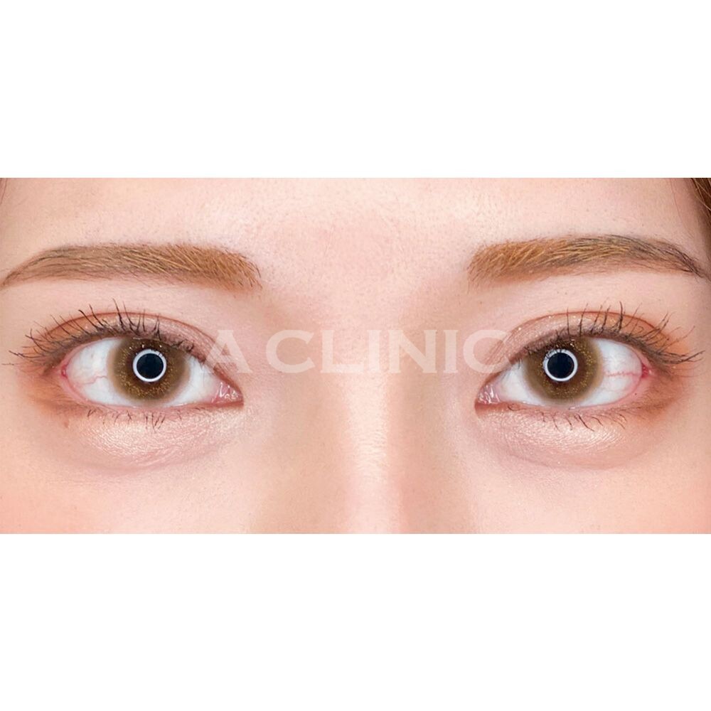 ツリ目でお悩みの方に！ナチュラル可愛いタレ目になれる！パーフェクトアイズの処置前と2週間後の症例です(20代女性) AFTER