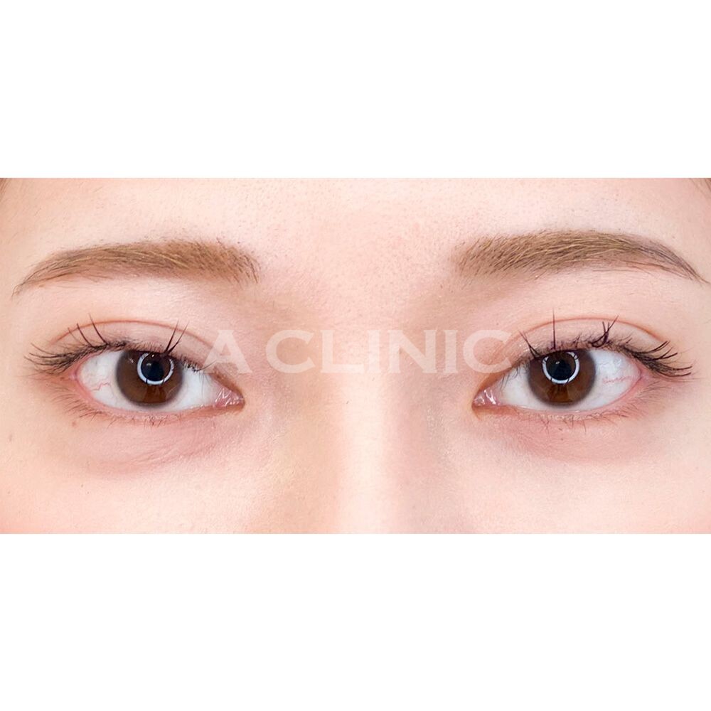 ツリ目でお悩みの方に！ナチュラル可愛いタレ目になれる！パーフェクトアイズの処置前と2週間後の症例です(20代女性) BEFORE