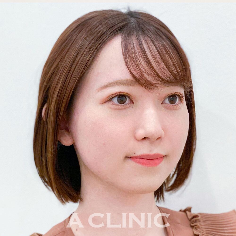 たった15分で顔痩せ！輪郭も整えるAスレッド 処置前と処置直後の症例です(20代女性) AFTER