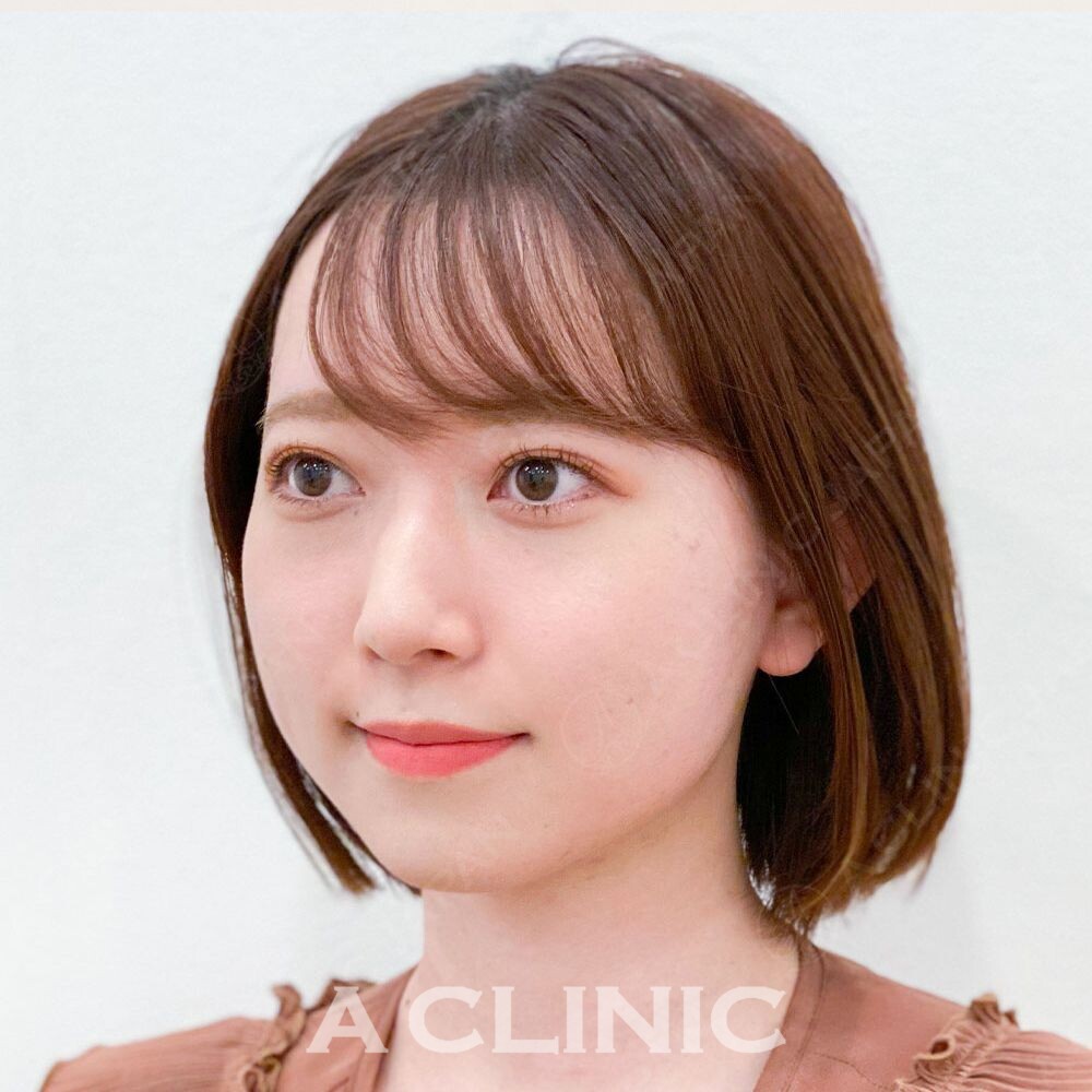 自然な小顔を叶えるAスレッド！Aスレッド処置前と処置直後の症例です(20代女性) AFTER