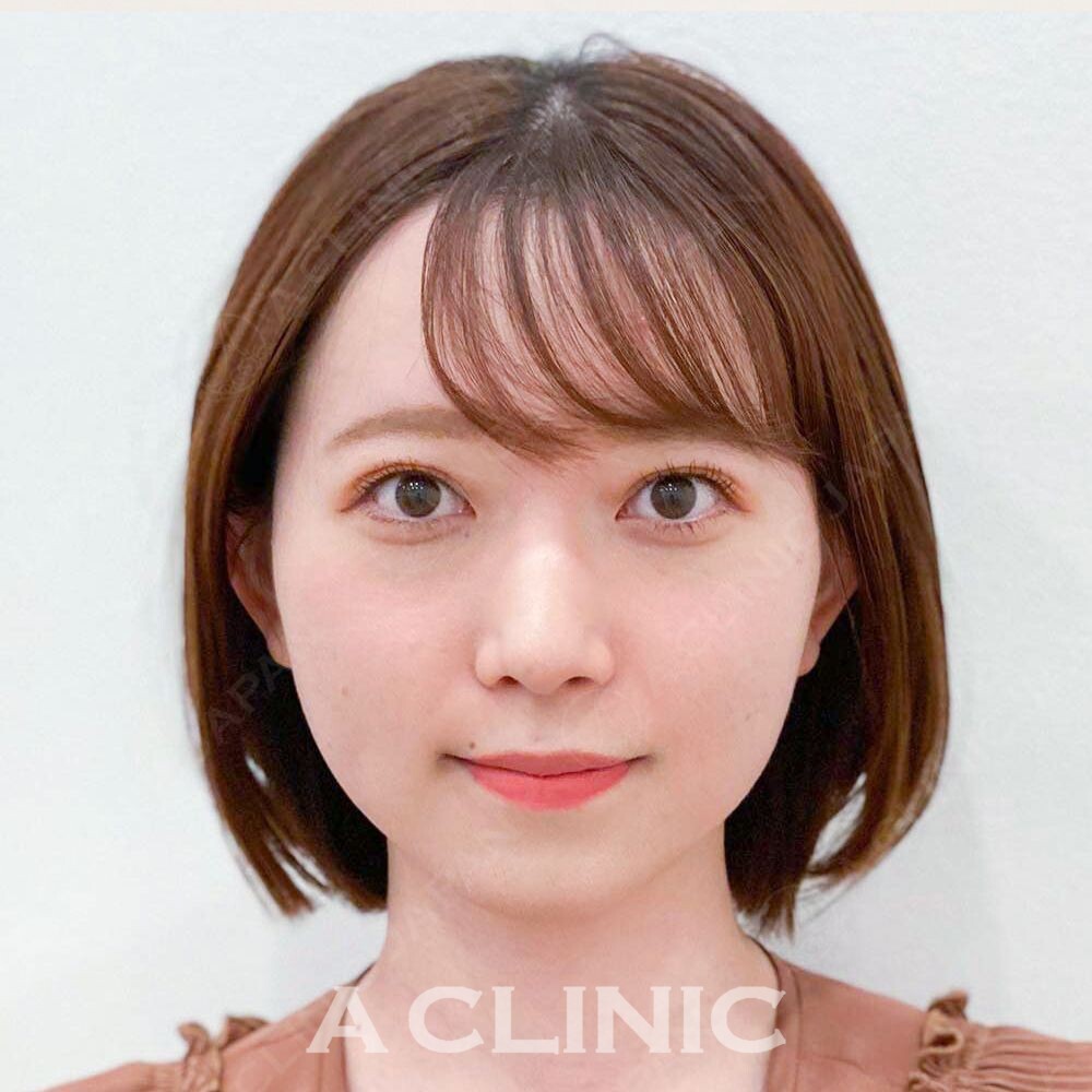 Aスレッドでお顔の余白が減らせます！こちらAスレッド処置前と処置直後です(20代女性) AFTER