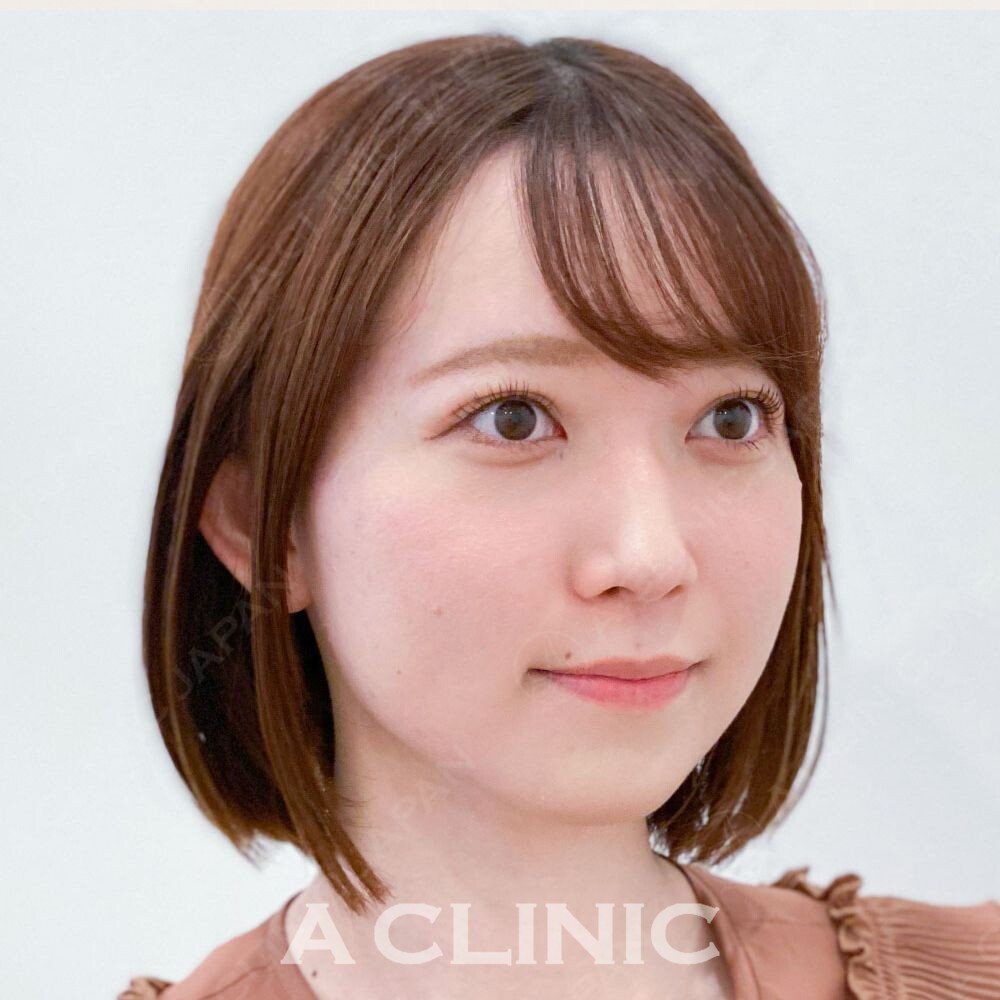 たった15分で顔痩せ！輪郭も整えるAスレッド 処置前と処置直後の症例です(20代女性) BEFORE