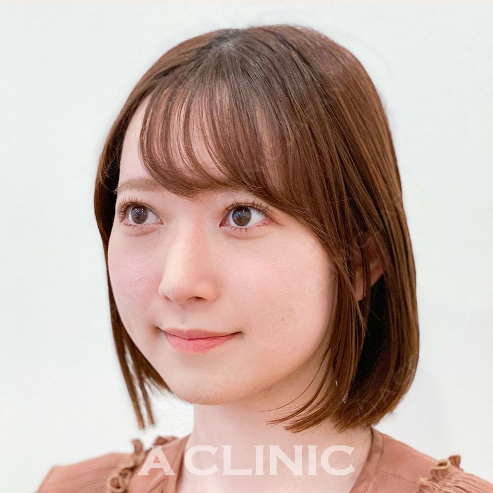 自然な小顔を叶えるAスレッド！Aスレッド処置前と処置直後の症例です(20代女性) BEFORE