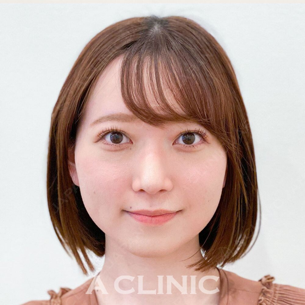 Aスレッドでお顔の余白が減らせます！こちらAスレッド処置前と処置直後です(20代女性) BEFORE