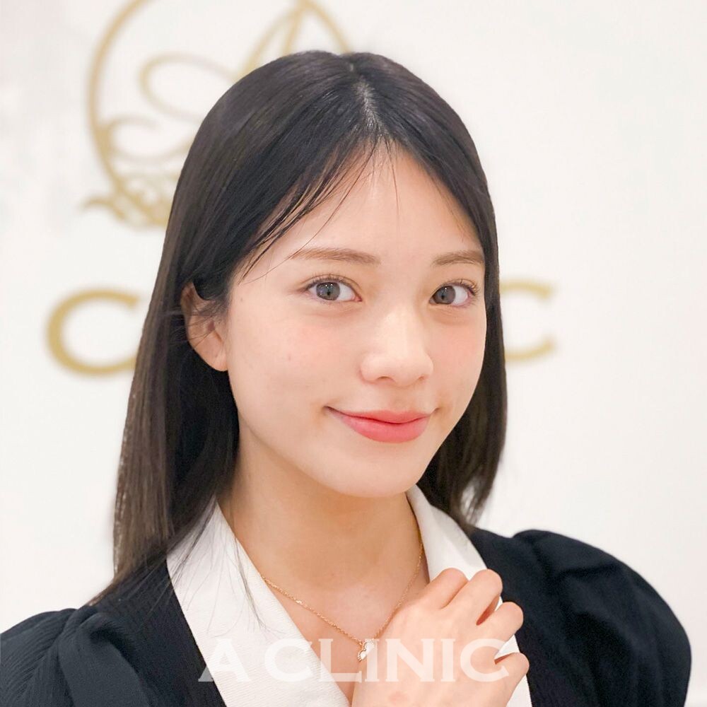 小顔になると美人度が倍増します！1day小顔脂肪吸引の処置前と1ヶ月後の症例です(20代女性) BEFORE