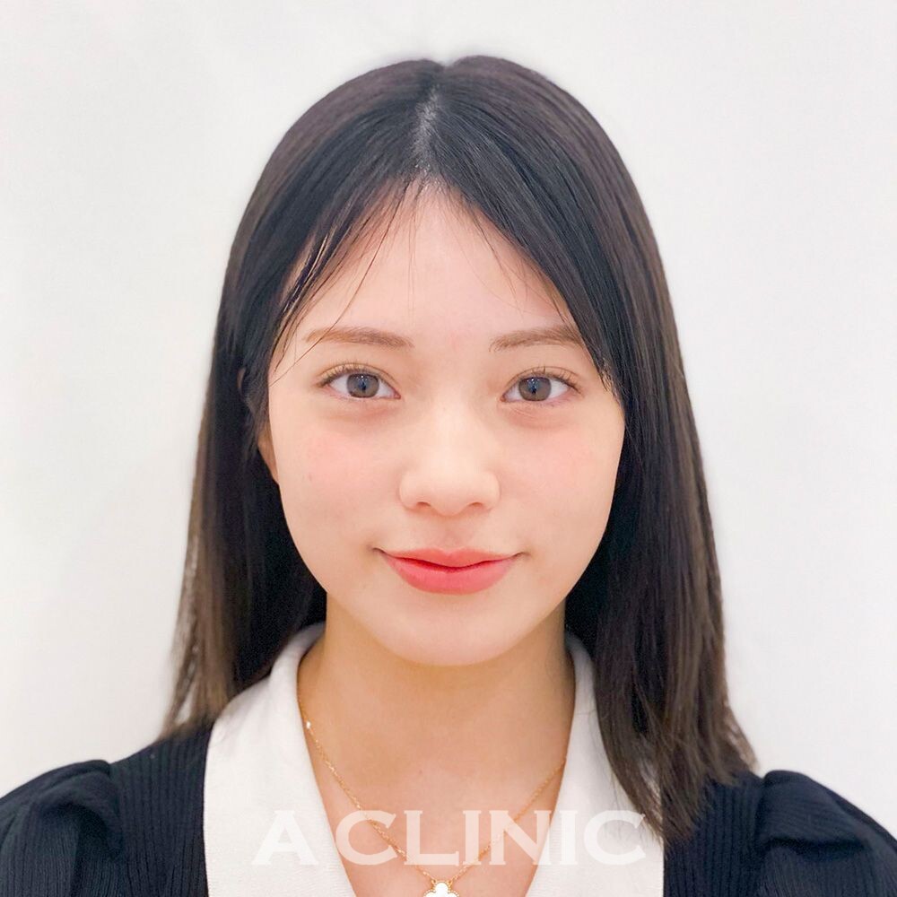 顔の脂肪が減るだけでこんなに印象は変わります！1day小顔脂肪吸引の処置前と1ヶ月後の症例です(20代女性) BEFORE