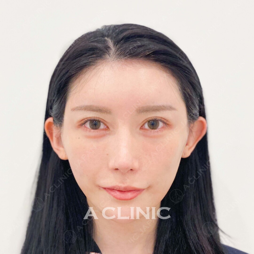 Aスレッドで小顔だけでなく、肌にハリとうるおいも！処置前と処置直後の症例です(20代女性) AFTER