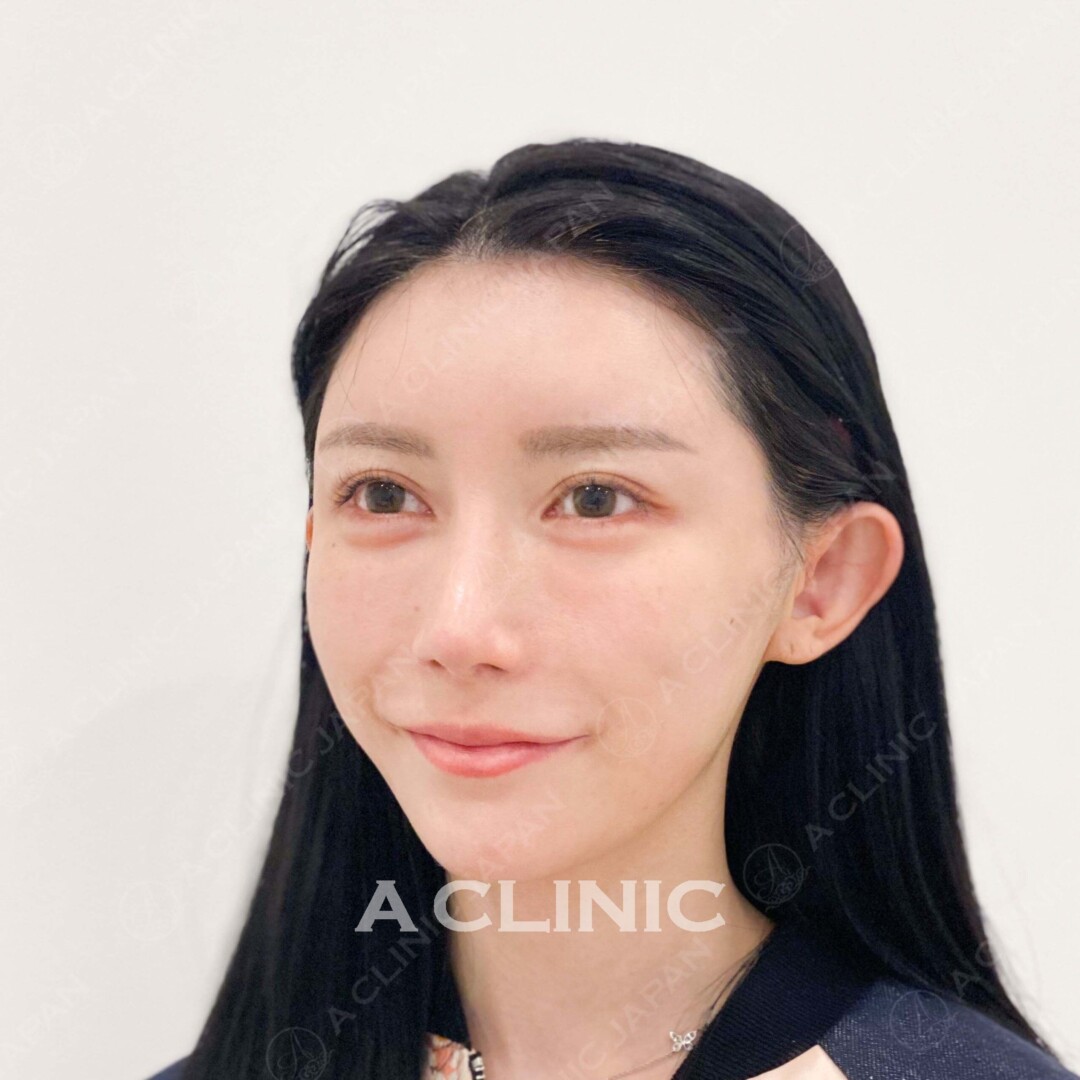 Aスレッドで美肌効果も実感できる！処置前と処置直後の症例です（20代女性） AFTER