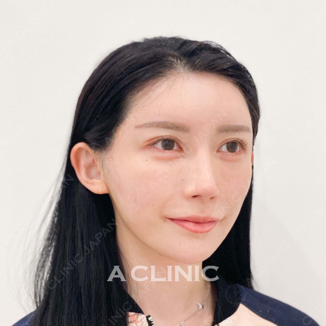 Aスレッドでしっかり自然にたるみを解消！処置前と処置直後の症例です(20代女性) AFTER