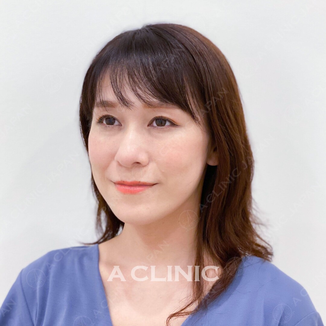 顔のたるみに悩んでいませんか？Aスレッドは即日でリフトアップが可能です。処置前と処置後の症例です（30代女性） AFTER