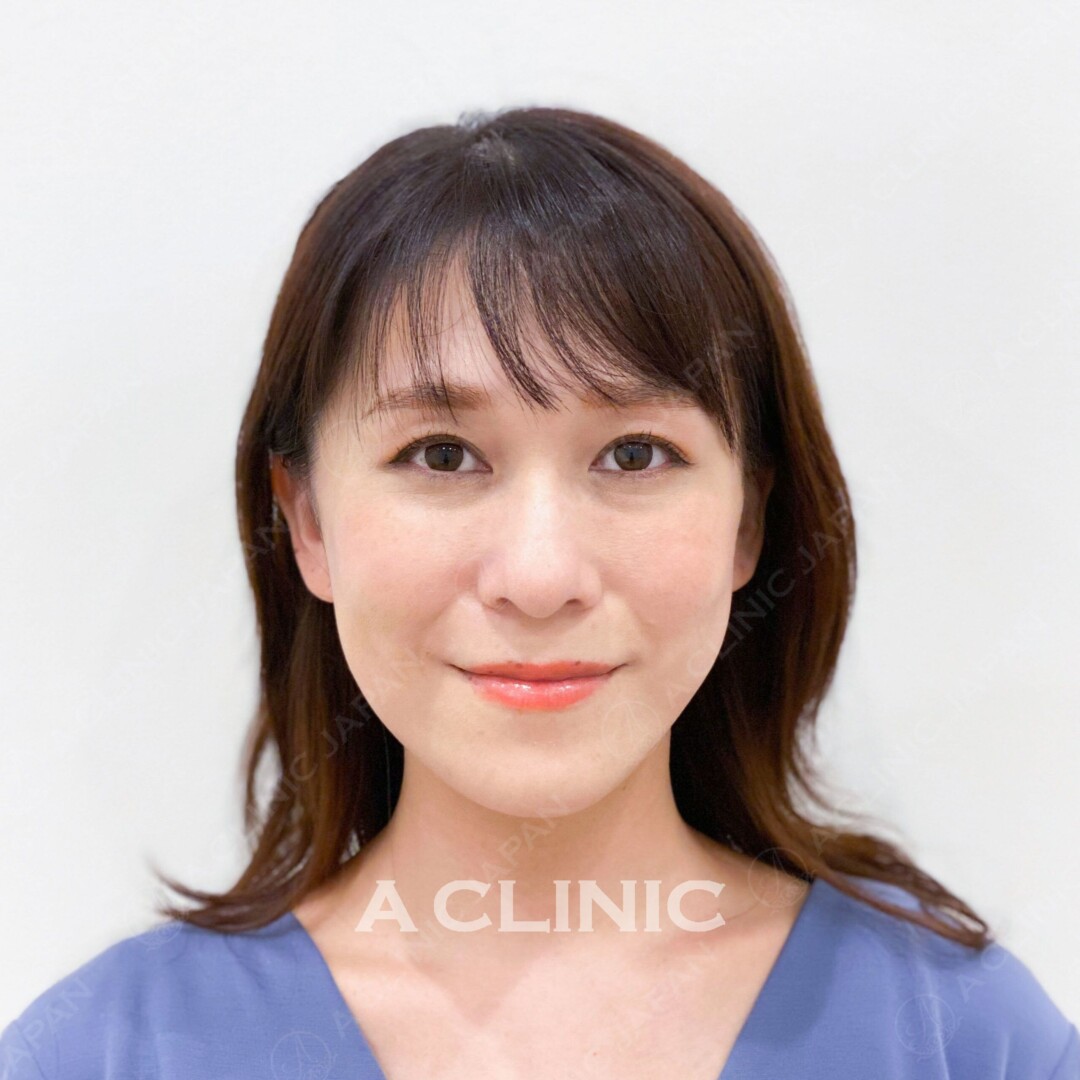 Aスレッドで顔のたるみを解消！アンチエイジング効果も抜群！Aスレッドの術前と術後の症例です（30代女性） AFTER