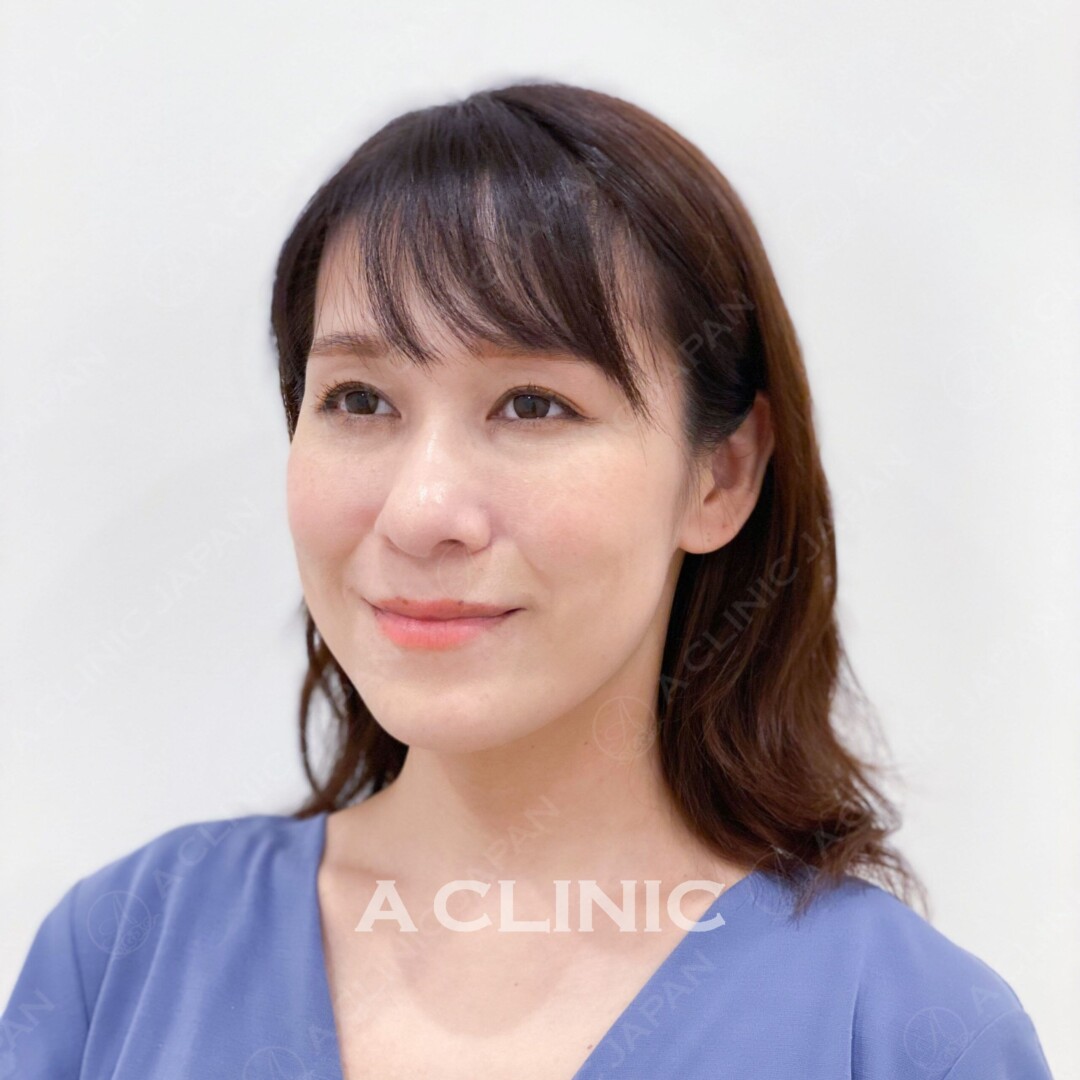 顔のたるみに悩んでいませんか？Aスレッドは即日でリフトアップが可能です。処置前と処置後の症例です（30代女性） BEFORE