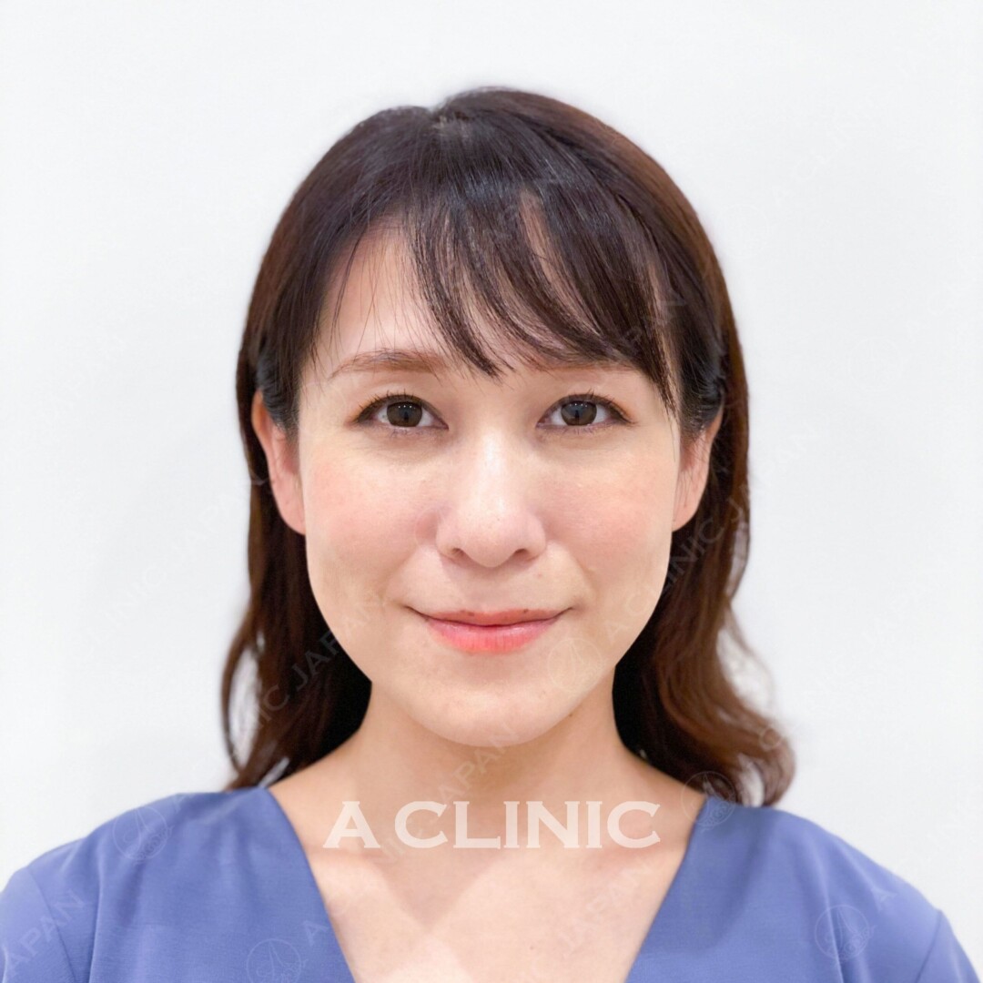 Aスレッドで顔のたるみを解消！アンチエイジング効果も抜群！Aスレッドの術前と術後の症例です（30代女性） BEFORE