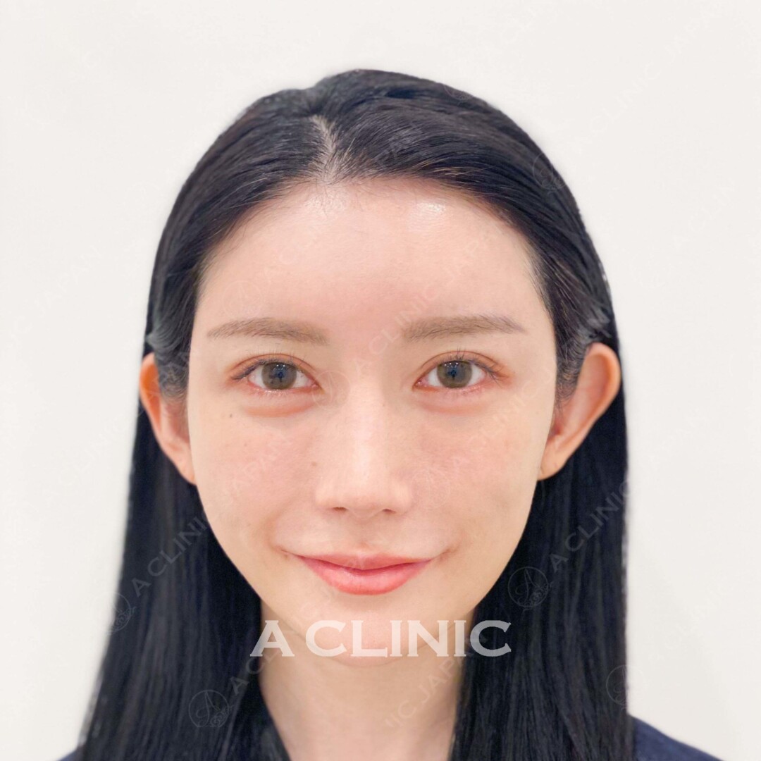 Aスレッドで小顔だけでなく、肌にハリとうるおいも！処置前と処置直後の症例です(20代女性) BEFORE