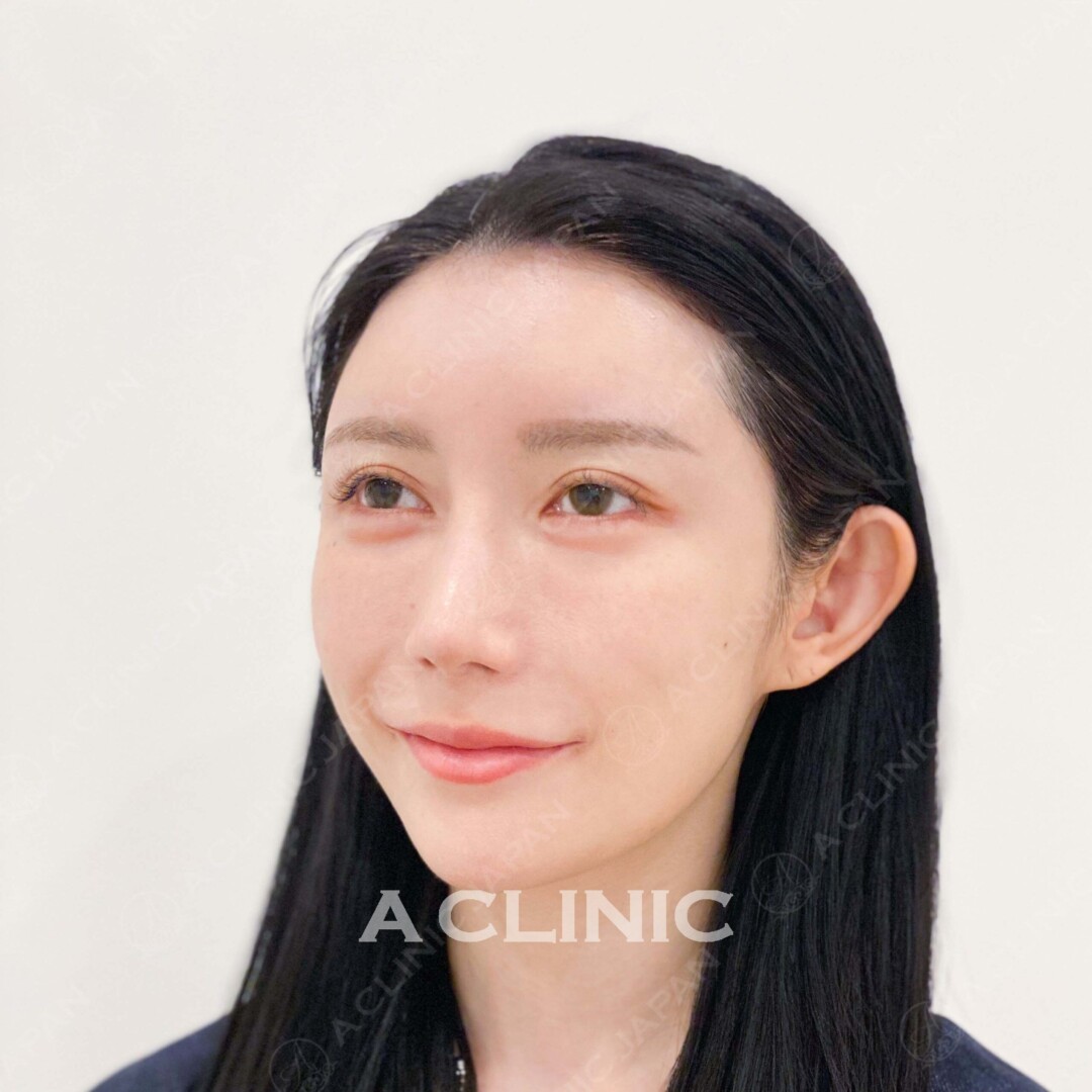 Aスレッドで美肌効果も実感できる！処置前と処置直後の症例です（20代女性） BEFORE