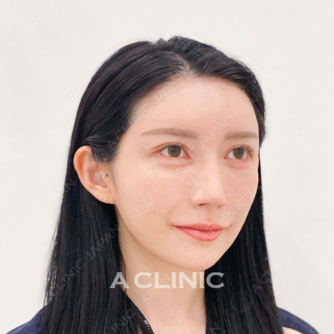 Aスレッドでしっかり自然にたるみを解消！処置前と処置直後の症例です(20代女性) BEFORE