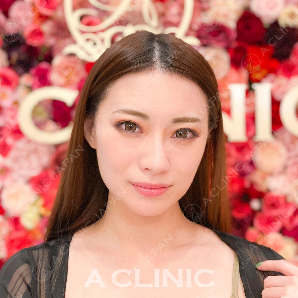 輪郭の脂肪やたるみも即日解消！小顔Aスレッドの処置前と処置直後の症例です(30代女性) AFTER