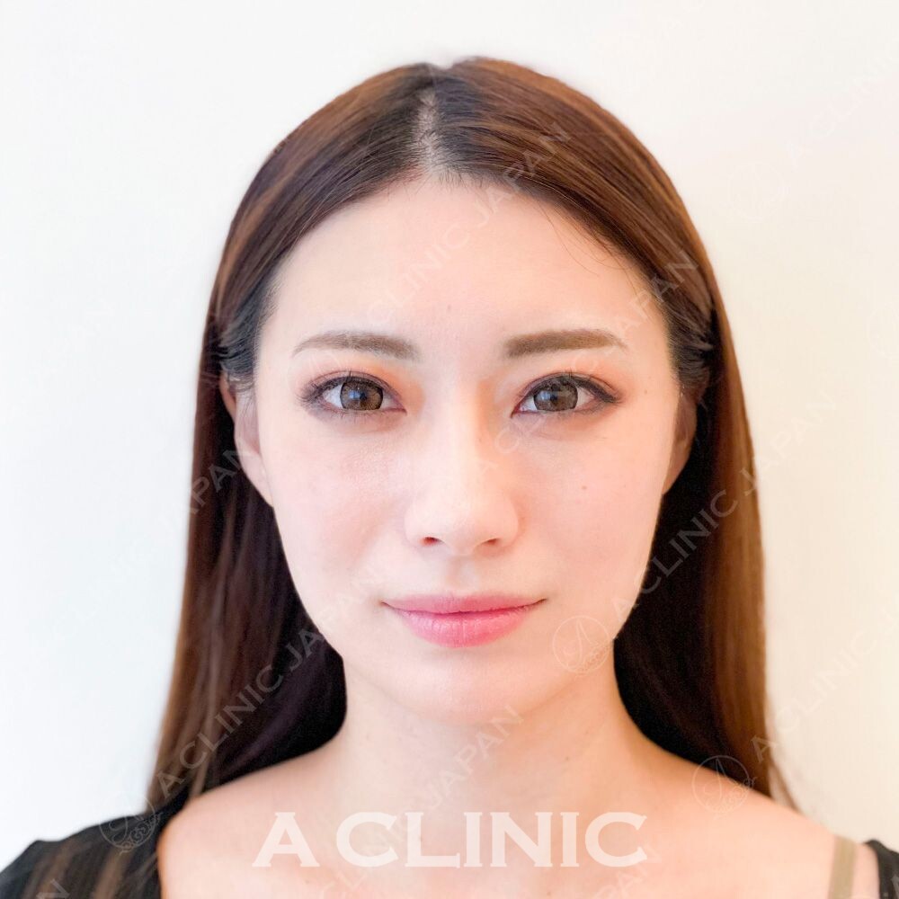 小顔と美肌そしてエイジングケアがすべて叶います！Aスレッドの処置前と処置直後の症例です(30代女性) AFTER