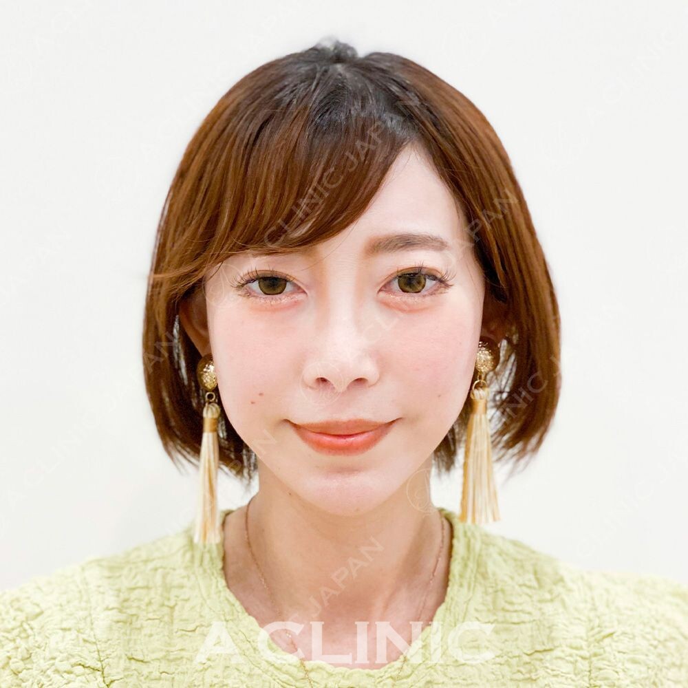 糸リフトで直後から小顔に！Aスレッドの処置前と処置直後の症例です(30代女性) AFTER