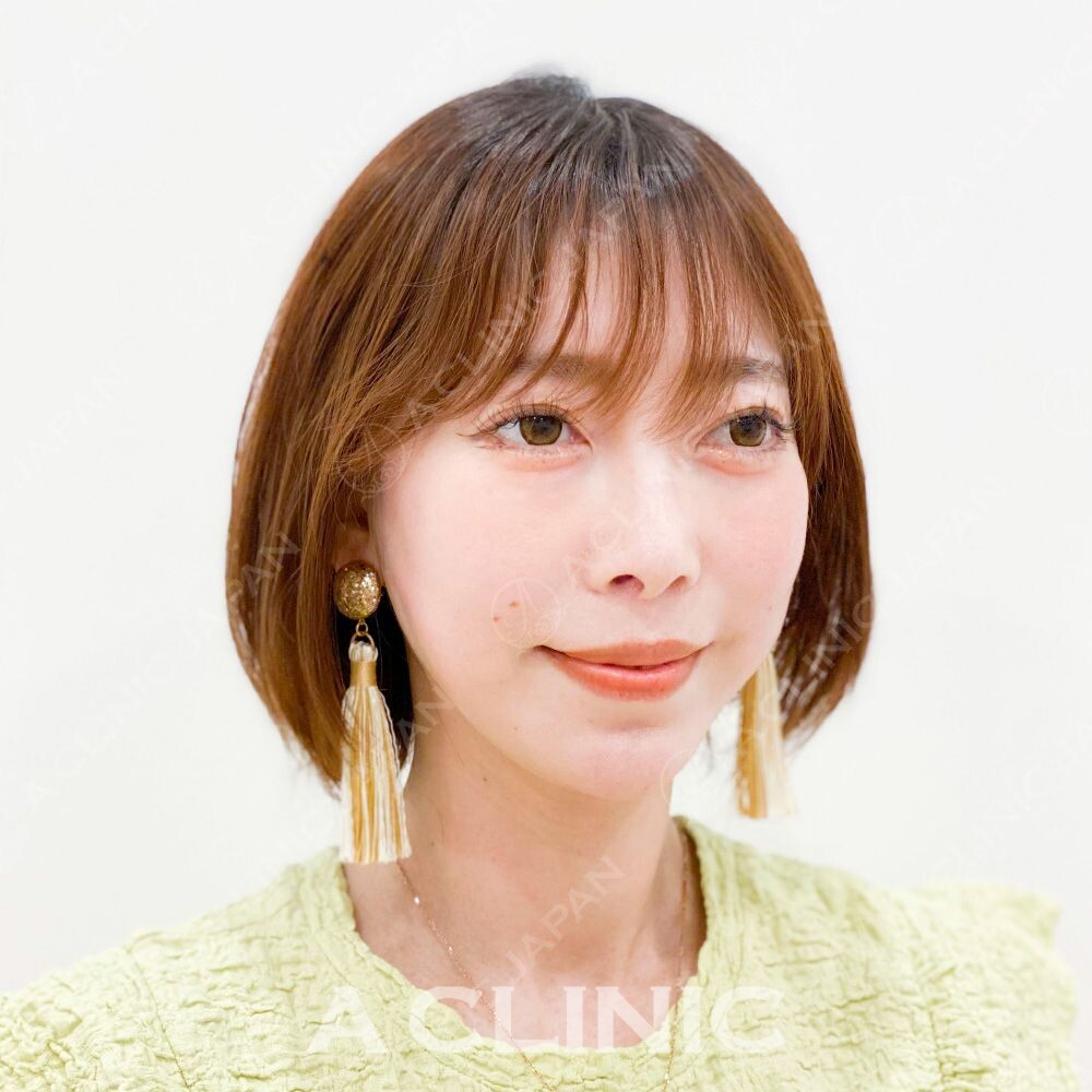 即日で小顔が叶うAスレッド！処置前と処置直後の症例です(30代女性) AFTER