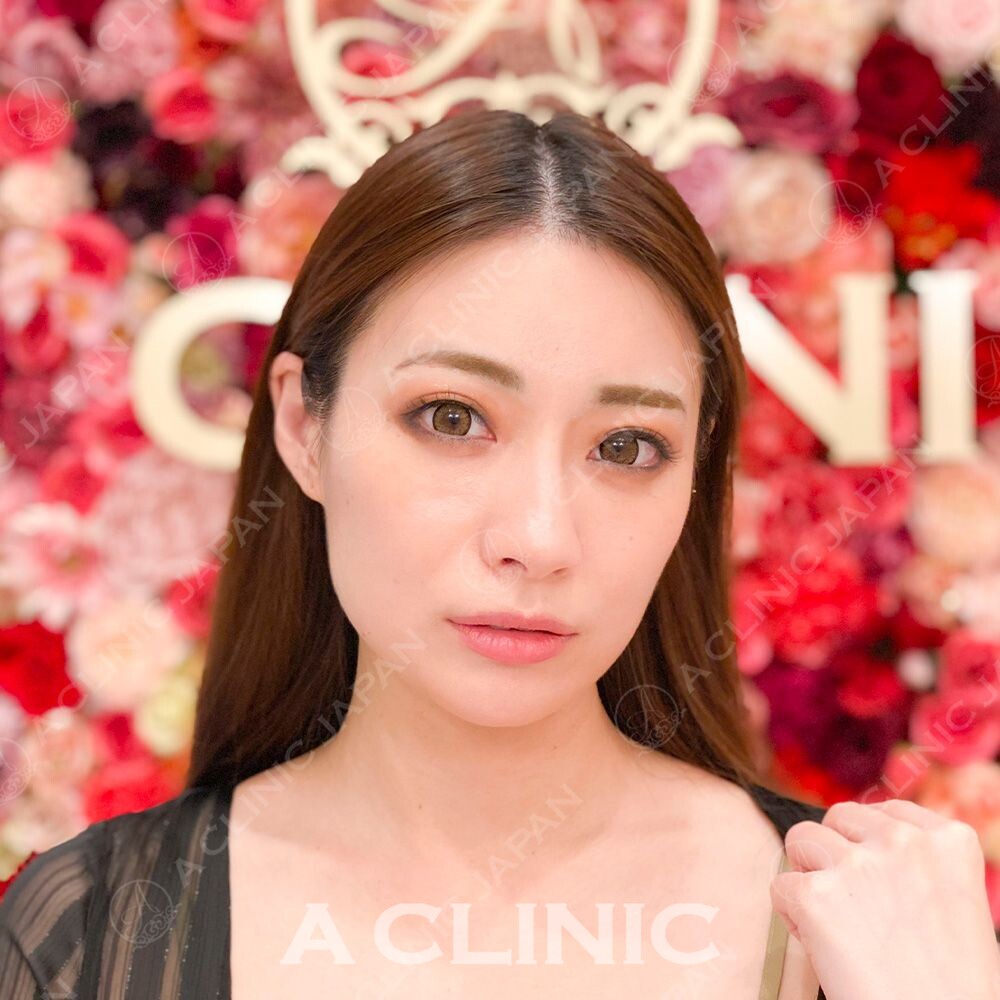 輪郭の脂肪やたるみも即日解消！小顔Aスレッドの処置前と処置直後の症例です(30代女性) BEFORE