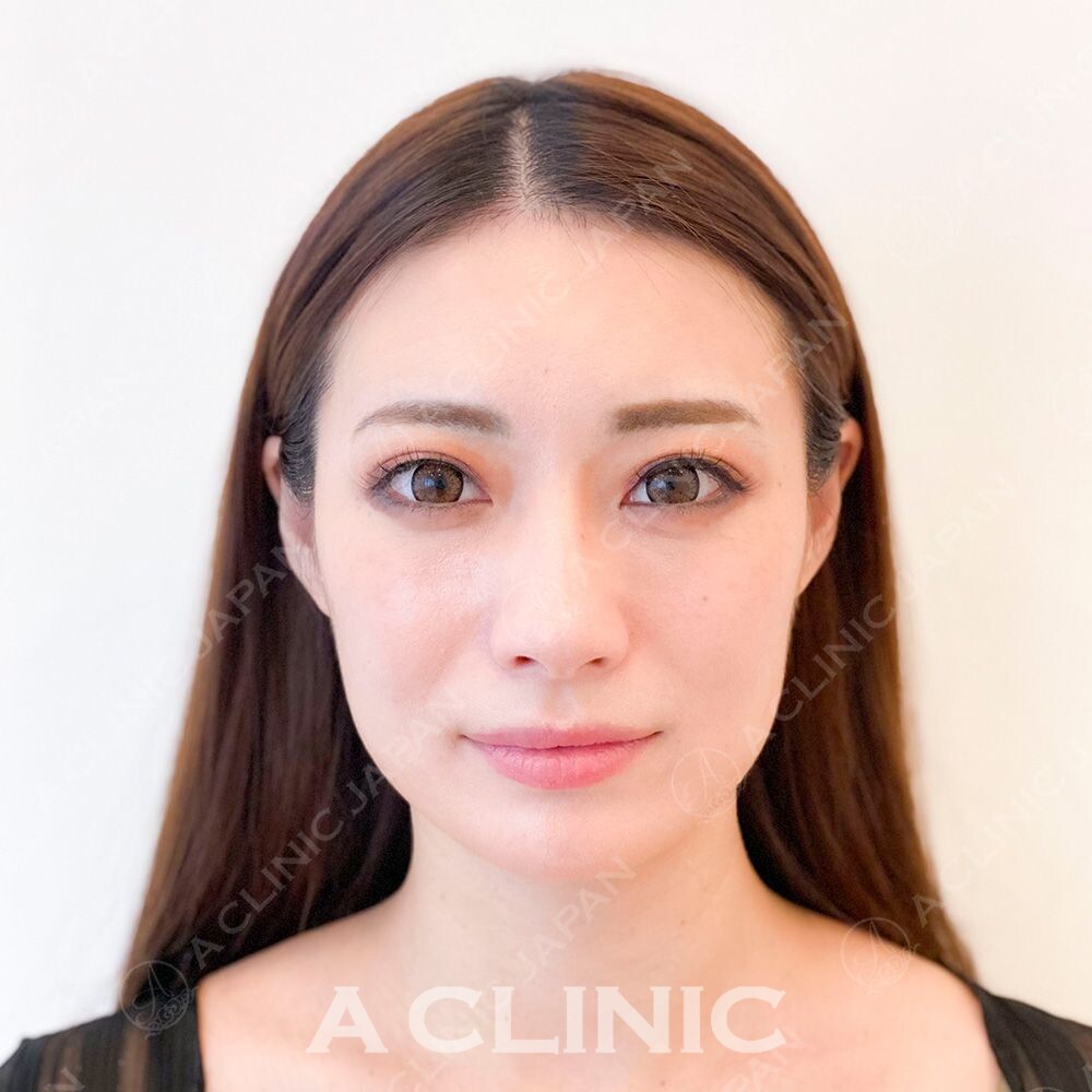 小顔と美肌そしてエイジングケアがすべて叶います！Aスレッドの処置前と処置直後の症例です(30代女性) BEFORE