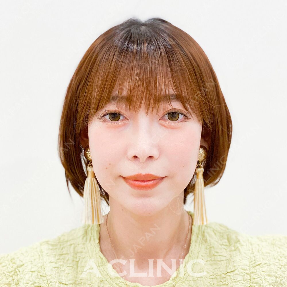 糸リフトで直後から小顔に！Aスレッドの処置前と処置直後の症例です(30代女性) BEFORE