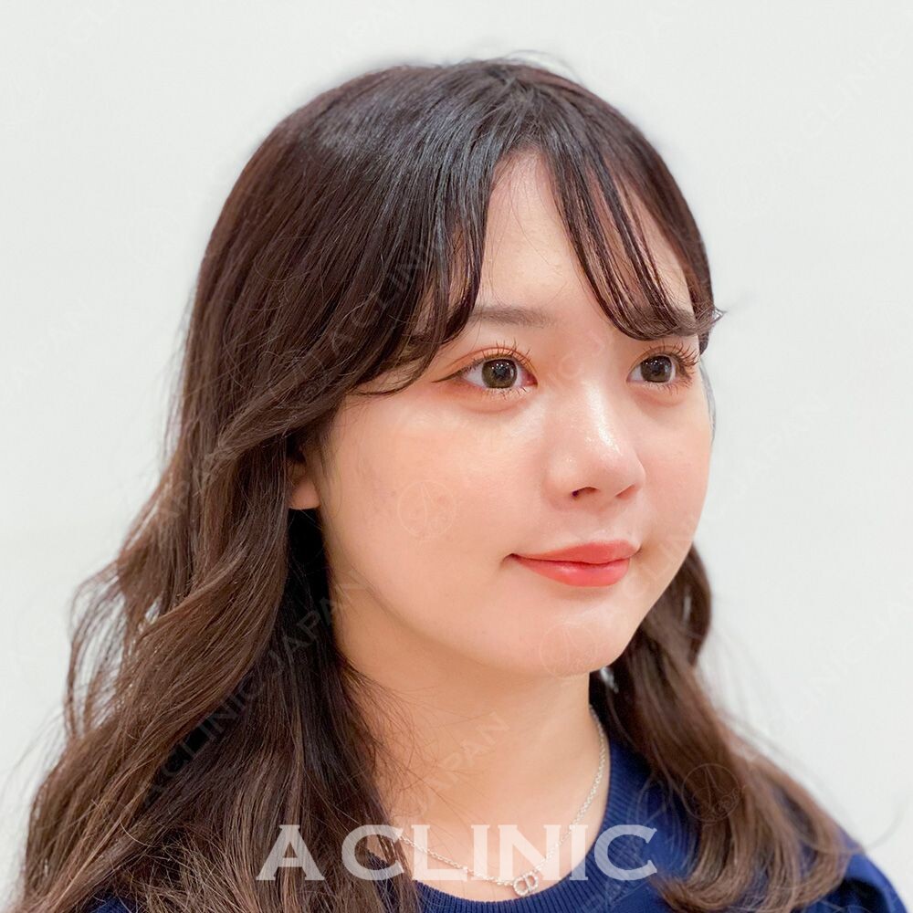 従来の糸リフトよりも腫れやダウンタイムが最小限です！Aスレッドの処置前と処置直後の症例です(10代女性) BEFORE