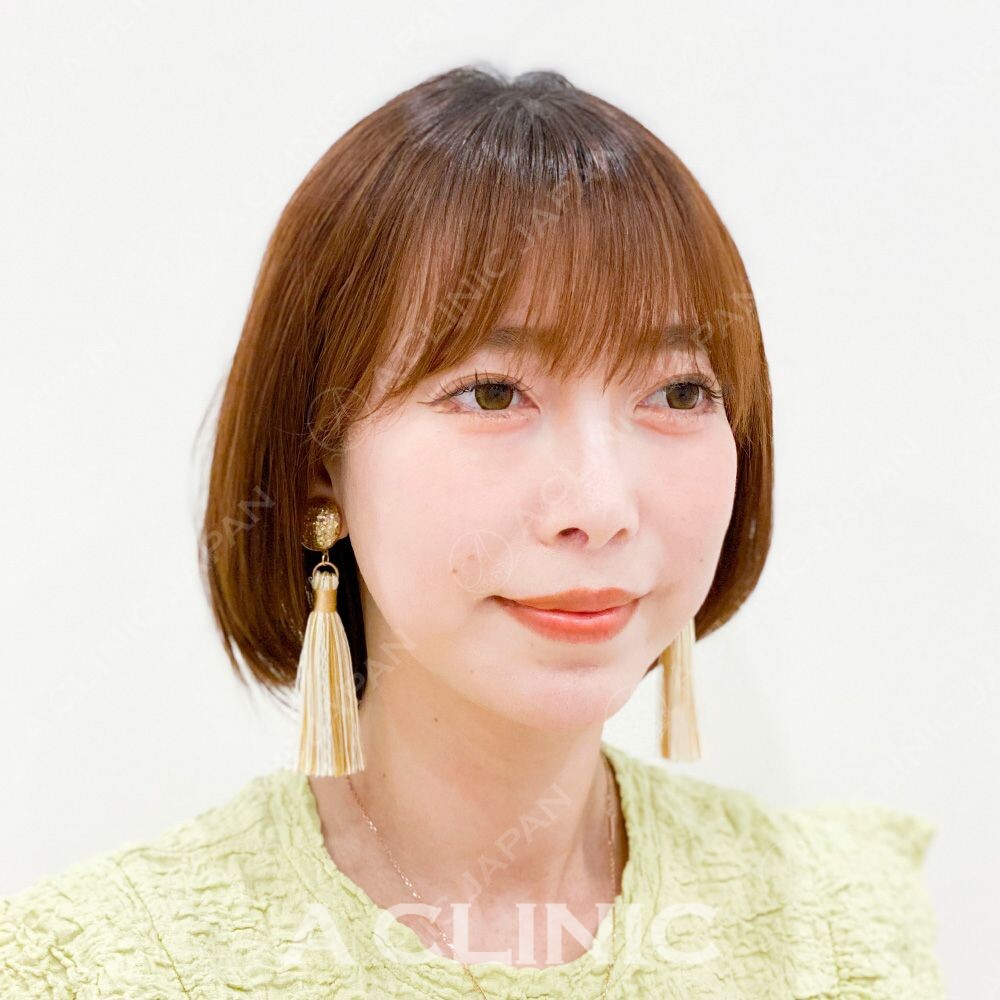 即日で小顔が叶うAスレッド！処置前と処置直後の症例です(30代女性) BEFORE