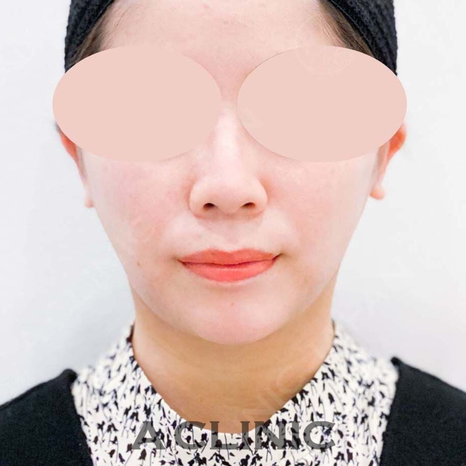 固定バンド不要の脂肪吸引！腫れやダウンタイムの少ない1day小顔脂肪吸引の処置前と処置翌日の症例です！(20代女性) AFTER