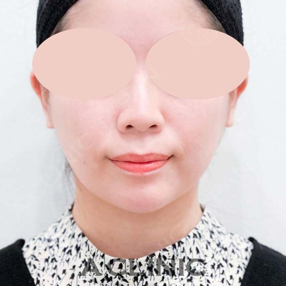 固定バンド不要の脂肪吸引！腫れやダウンタイムの少ない1day小顔脂肪吸引の処置前と処置翌日の症例です！(20代女性) BEFORE