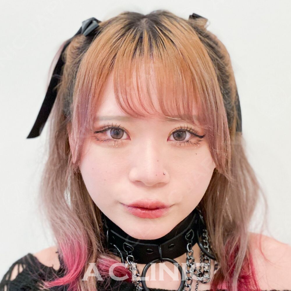 1day小顔脂肪吸引なら直後から小顔効果を実感！こちら処置前と処置直後の症例です(20代女性) AFTER