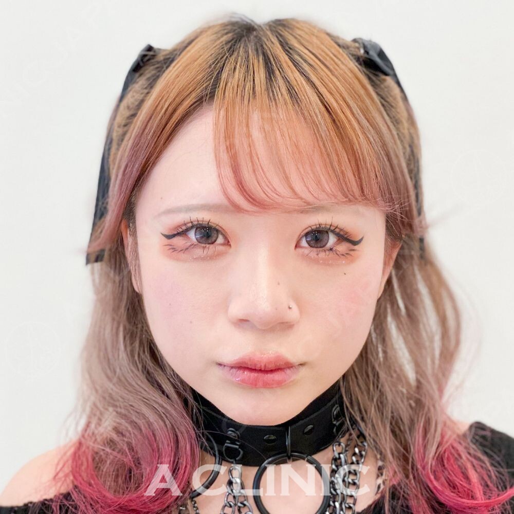 1day小顔脂肪吸引なら直後から小顔効果を実感！こちら処置前と処置直後の症例です(20代女性) BEFORE