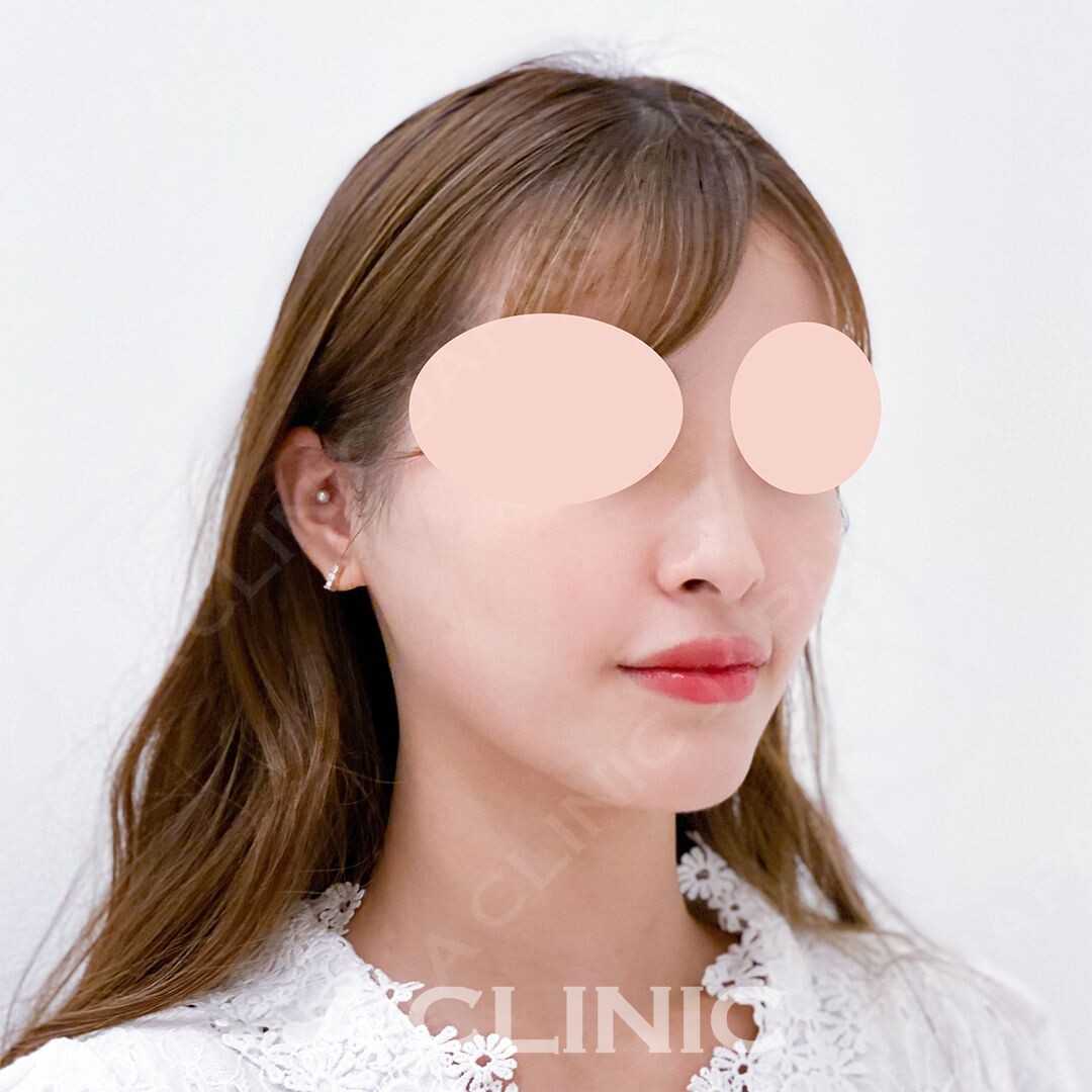 腫れずに小顔になりたい方必見です。Aスレッドで処置直後から理想の小顔に(20代女性) AFTER