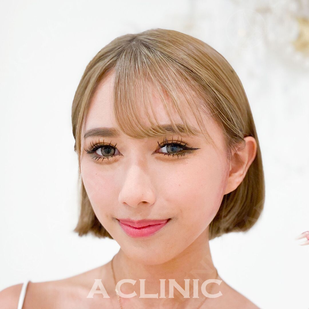 垢抜け小顔美人に15分で変身。即日小顔術Aスレッドの処置直後の症例です(20代女性) AFTER